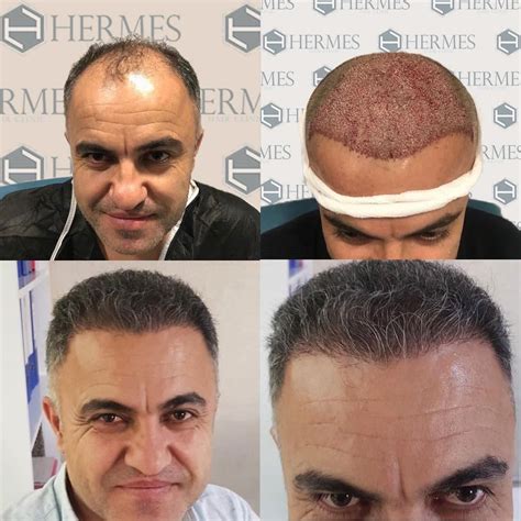 hermes hair clinic reviews.